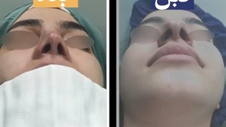 نمونه جراحى زیبایى بینى دکتر على طاهری نیا لیفت ابرو