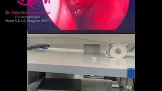 فیلم واقعی جراحی سینوس به روش آندوسکوپی