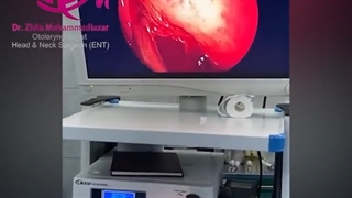 فیلم واقعی عمل سینوزیت