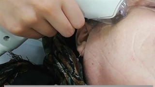 انجام تیکسل جهت جوانسازی وکلاژن سازی پوست تحت نظر دکتر ناهید همتیان درکلینیک تخصصی جوان لیپوساکشن