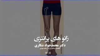 ناهنجاری زانوی پرانتزی