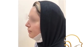 رینوپلاستی