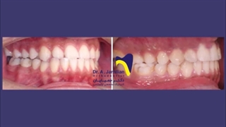 عکس های قبل و بعد از درمان ارتودنسی / متخصص ارتودنسی / دکتر جمیلیان