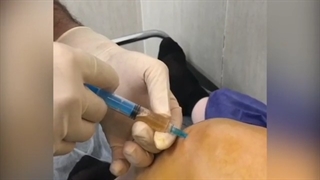 درمان پارگی لیگمال با تکنیک PRP