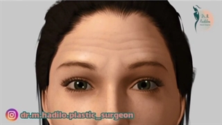 نحوه تزریق بوتاکس به پیشانی دندان پیش