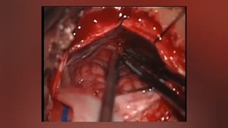 تومور شوانوم CPA بزرگ