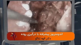 جراحی اندومتریوز با درگیری روده