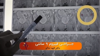 جراحی میوم رحم