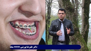 دکتر علیرضا پورنبی ناهنجاری #open_bite قدامی فکین می گوید