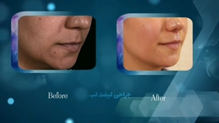 جراحی لیفت لب | دکتر یحیوی