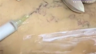 فیلم اسکلروتراپی روی ران و پشت زانو