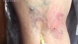 فیلم واقعی اسکلرودرمی عروق پشت زانو در خانم جوان