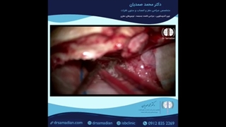 مننژیوم کلینوئیدال