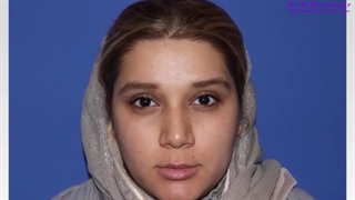 نتیجه جراحی بینی نیمه فانتزی