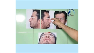 عمل جراحی بینی برای آقای جوان