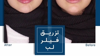 تزریق فیلر لب
