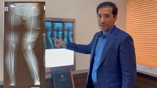 عمل تعویض مفصل زانو در خانم 51 ساله