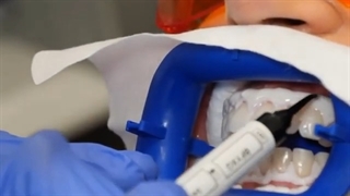 بلیچینگ دندان | کلینیک تخصصی دندانپزشکی کانسپتا