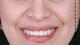 نمونه درمان ارتودنسی ثابت | کلینیک تخصصی دندانپزشکی کانسپتا