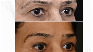 فیلم عمل لیفت پیشانی