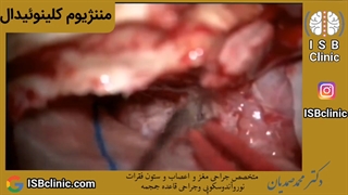 مننژیوم کلینوئیدال