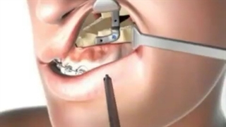 جراحی ارتودنسی دندان