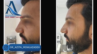 نمونه کارهای تزریق فیلر بینی