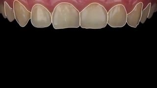 اصلاح طرح لبخند