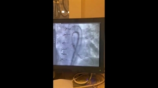 کارگزاری دریچه آئورت مصنوعی به روش آنژیوگرافیک