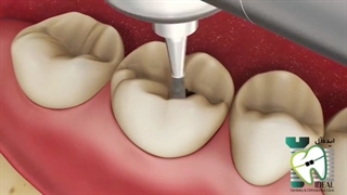 اینله کردن دندان ها چیست ؟ | کلینیک دندانپزشکی ایده آل