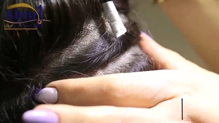 محل برداشت مو در کاشت ابرو | کلینیک ابروان