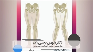 علت ایجاد زانوی ضربدری