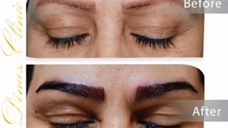 نمونه کاشت ابرو در کلینیک دیناز