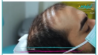 مزوتراپی لمینت