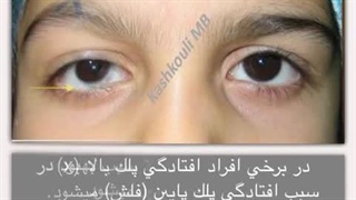 نمونه جراحی افتادگی پلک بالا | پروفسور کشکولی | جراح پلک تهران