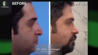 چهارماه بعد از جراحی بینی مردانه | دکتر باستانی نژاد | جراح بینی