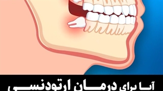 کشیدن دندان عقل برای درمان ارتودنسی | دکتر فرهاد گرجی