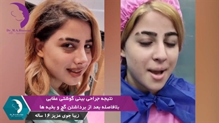 عمل بینی گوشتی در نوجوان 16 ساله