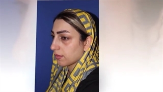 اصلاح قوز بینی و افتادگی نوک