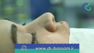 فیلم عمل جراحی بینی در اتاق عمل| دکتر علی بصام