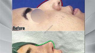 عمل زیبایی بینی | فوق تخصص جراحی پلاستیک | دکتر عبدالرضا روئین تن