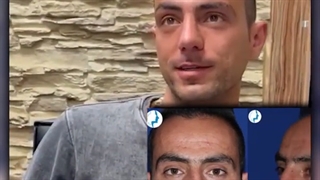 رضایت بیمار دو ماه بعد از جراحی زیبایی بینی | متخصص گوش و حلق و بینی | دکتر محمد گلی