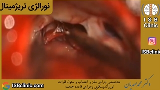 نورآلژی تریژمینال