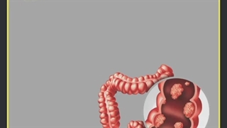 دلایل انجام کولونوسکوپی چیست؟