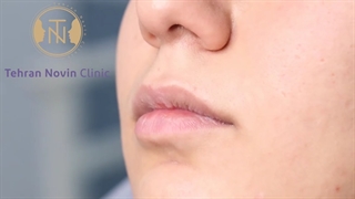 فیلم تزریق فیلر لب روسی از نزدیک