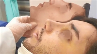 نتیجه بینی طبیعی مردانه