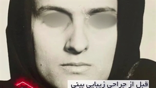 نمونه عمل بینی از دکتر احمد دانشی مربوط به 20 سال پیش