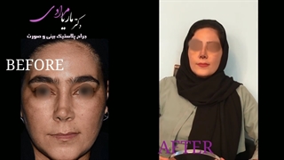 رضایت بیمار از نتیجه عمل بینی توسط دکتر ماریا مرادی