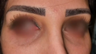 تزریق فیلر زیر چشم