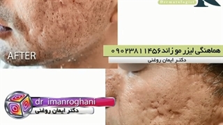درمان اسکار شدید آکنه اتوپلاستی